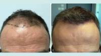 Hair Loss Treatments